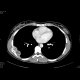 Ewing sarcoma of rib: CT - Computed tomography